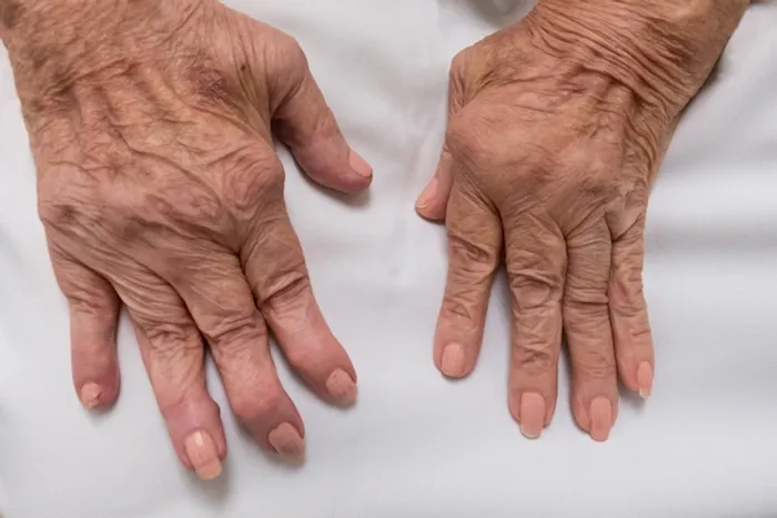 arthritis